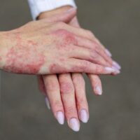 psoriasis